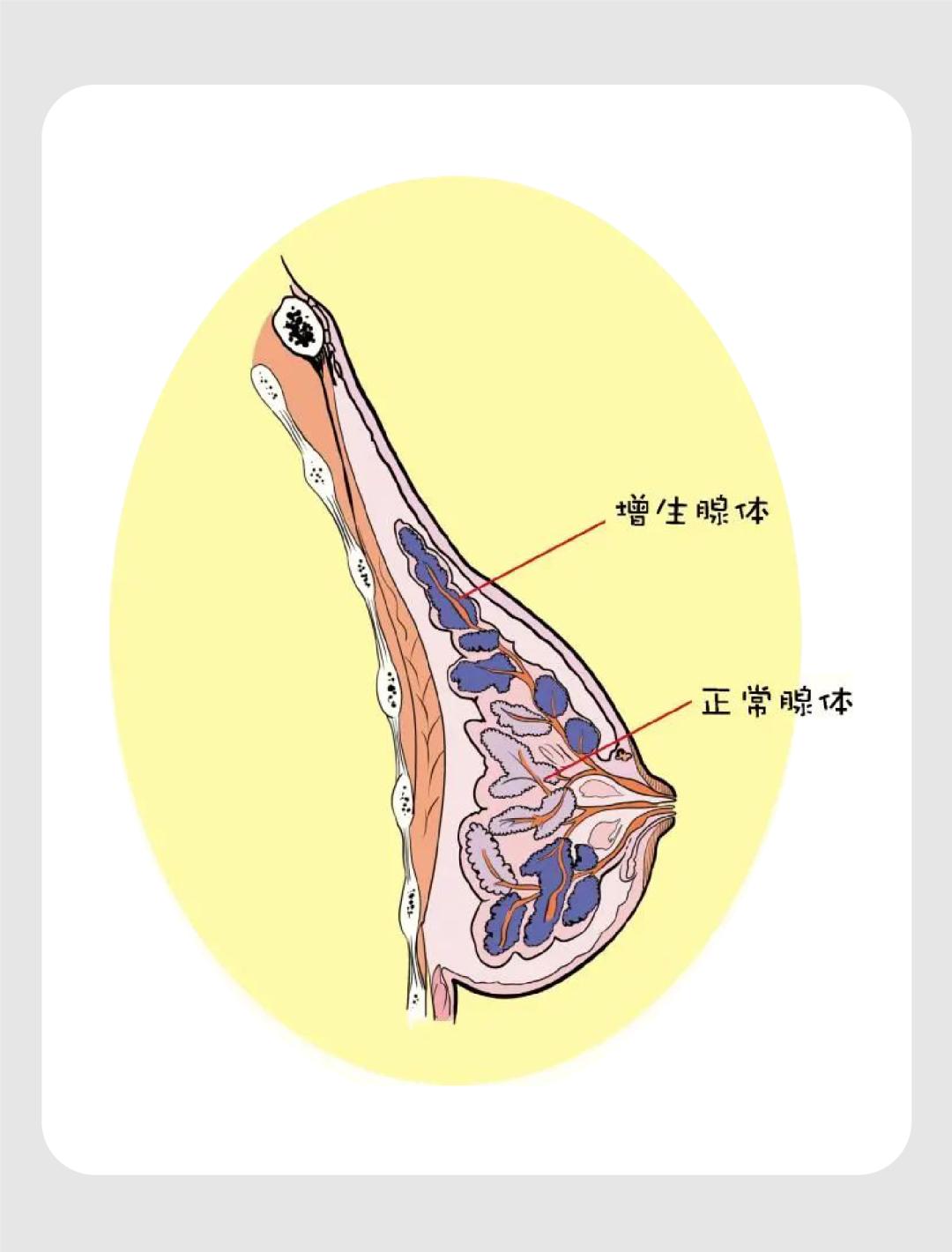 最新乳腺分型-乳腺分型新视角